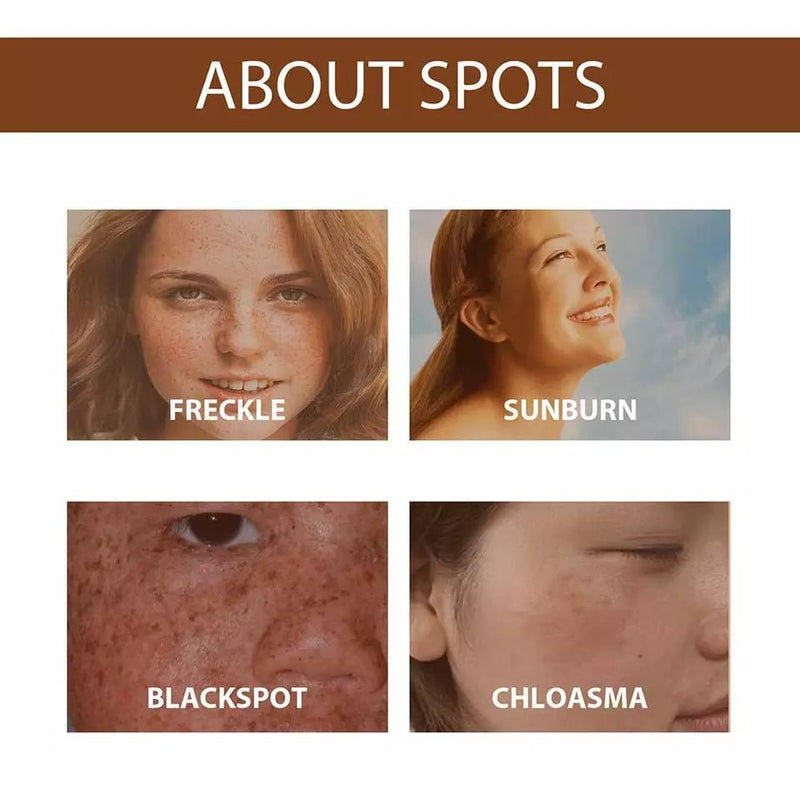 Anti-Freckle Serum (30ml) – A skin-brightening treatment designed to fade freckles, dark spots, and uneven pigmentation while deeply hydrating and protecting your skin